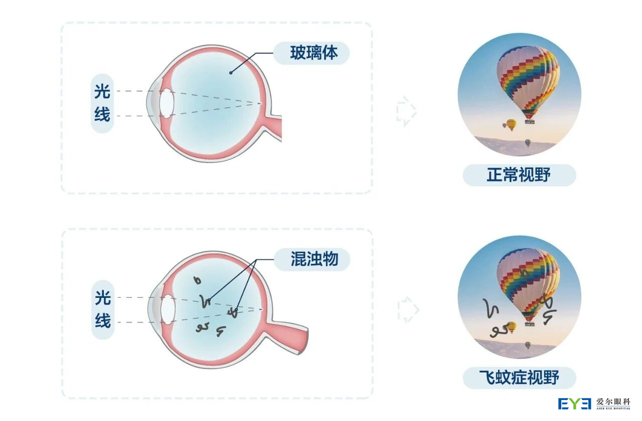 年轻人也会得飞蚊症？这2类人最易中招！