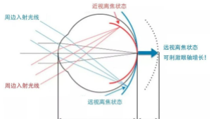不止OK镜！离焦软镜凭什么成为近视防控热门？
