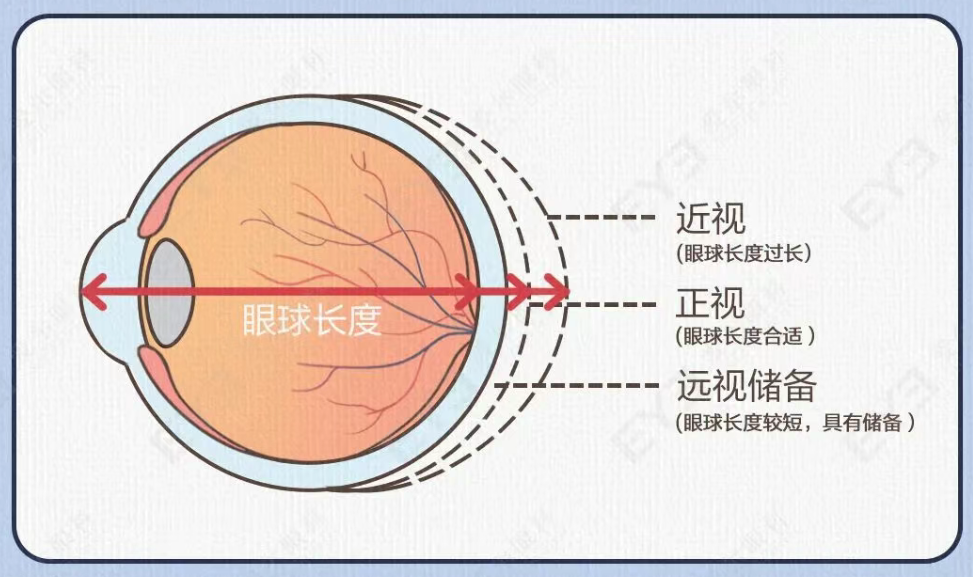 孩子近视总加深？这份暑期防控指南，家长看完少走一半弯路