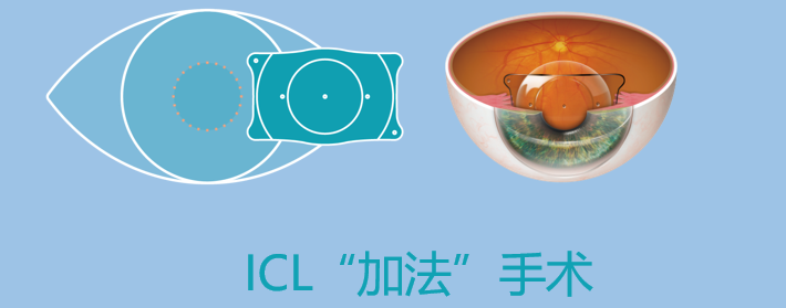 ICL晶体植入术常见问答