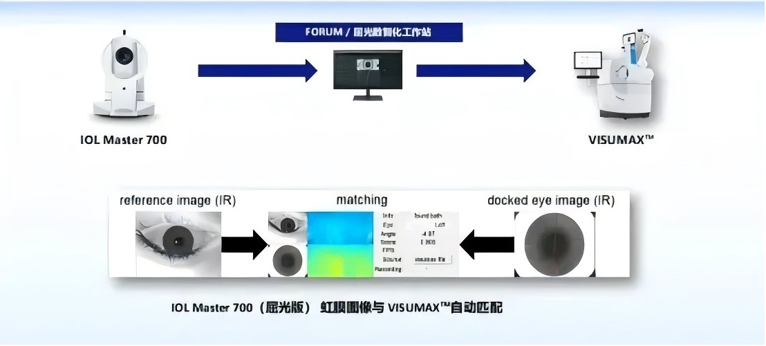 1°的精准，才是散光矫正的“安全感”——全飞秒SMILE Pro散光矫正增强版，自动校准轴位