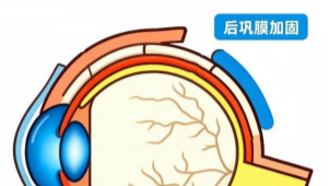 什么是后巩膜加固术?——为“吹胀的气球”加一层“防护甲”