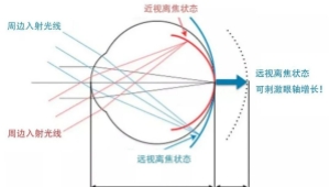  离焦眼镜配了没效果？多半栽在这几个细节上