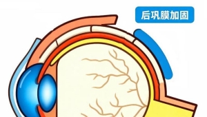 哪些人群可考虑后巩膜加固术？三类高风险人群需关注