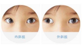 发生斜视如何矫治？听听医生怎么说