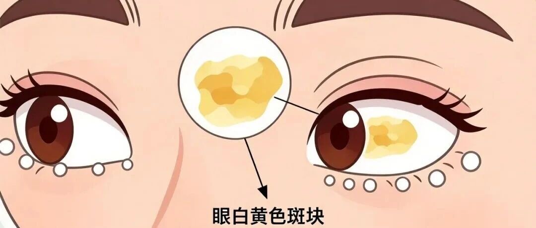 眼白上长了个“小斑块”？它被大多数人忽略